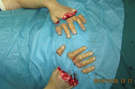 This Picture Is Unbelievable Woman Has All 10 Fingers Sliced Off In