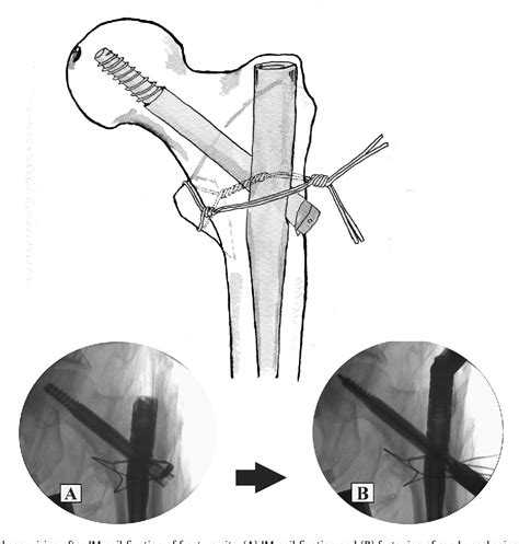 Figure 2 From Wiring Technique For Lesser Trochanter Fixation In