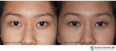 Blepharoplasty Asian Before After Cheaper Than Retail Price Buy Clothing Accessories And