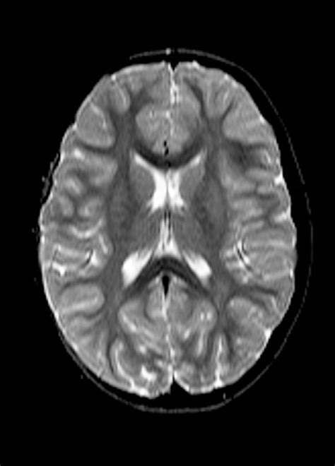 Childs Brain Mri Scan 4 Photograph By Du Cane Medical Imaging Ltd