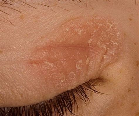 Eczema On Eyelids Eczema On Eyelids Eczema Eyelid Dermatitis