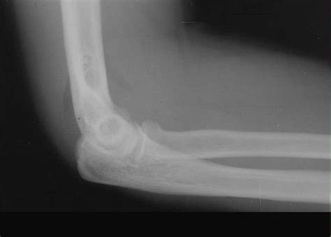 Fracture Radial Head On X Ray X Rays Case Studies Ctisus Ct Scanning