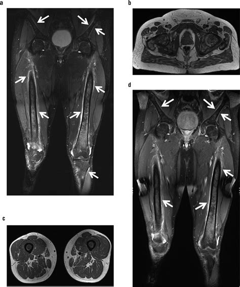 Marrow Infiltrative Process And Diffuse Periostitis On Mr Imaging A