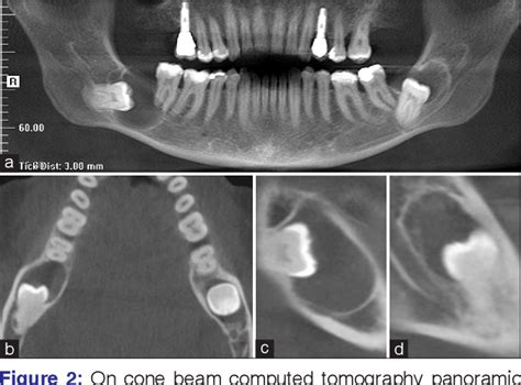 Figure From Unusual Bilateral Dentigerous Cysts In A Nonsyndromic