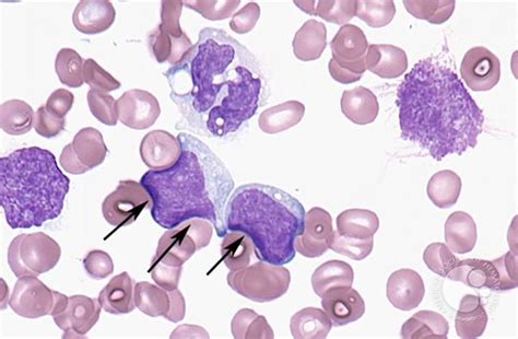 Reactive Lymphocyte Medical Laboratories Medical Laboratory