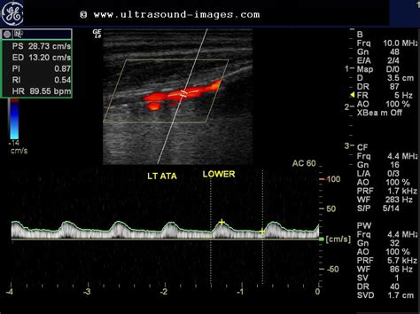 Ultrasound Imaging Doppler Study Severe Arterial Stenosis In Leg