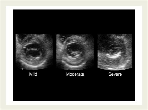 Figure 1 From Association Of Mitral Annular Calcification And Aortic