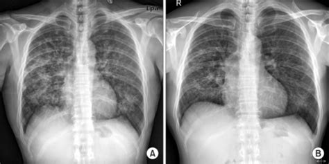 Chest X Ray Shows Bilateral Reticulonodular Infiltratio Open I