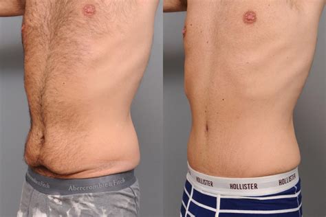 Tummy Tuck For Men In Nyc Dr Thomas Sterry
