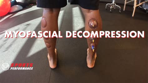 Cupping Therapy For The Foot Ankle And Calf Sports Performance