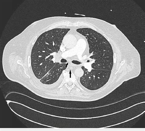 Axial View Of Ct Angiogram On Presentation Revealing Hilar And