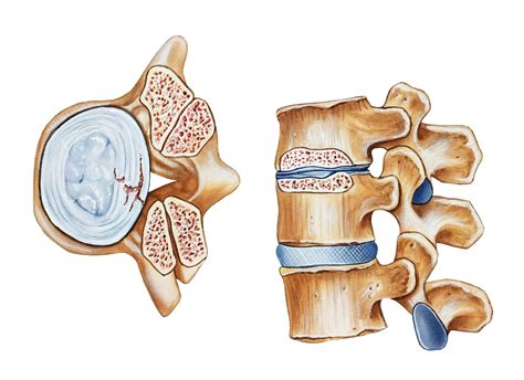 Spinal Stenosis Overview And More