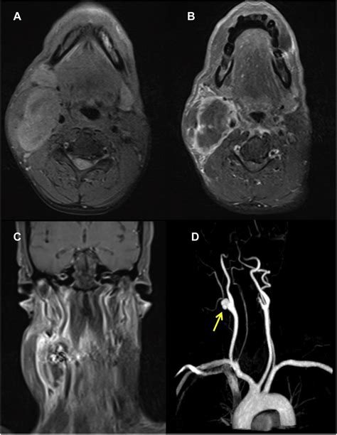Magnetic Resonance Imaging Of The Neck With Gadolinium Contrast A