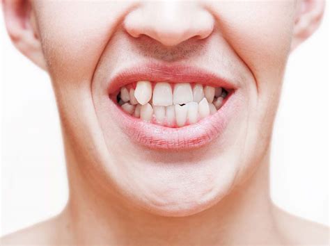 What Causes A Snaggletooth Smartsmileco