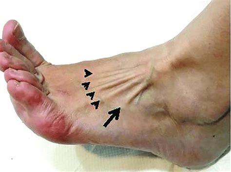 Dorsolateral View Of Left Foot And Ankle Showing The Tendons Of The
