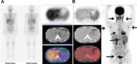 The Efficacy Of 18f Fdg Petct And 67ga Spectct In Diagnosing Fever Of