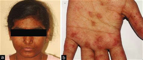 A And B Hyperpigmented Maculopapular Rash On The Face And Palm Of The