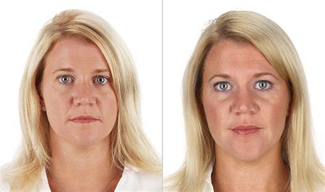 ‘vampire Face Lifts Selphyl Injections Of Your Blood Platelets The