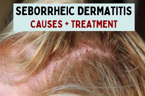 Seborrheic Dermatitis Dandruff And Cradle Cap Causes 47 Off