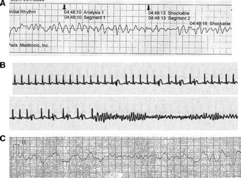 Она поступила в киношколу и скоро должна улететь в другой город. Ventricular fibrillation (Vf) seen in Patient 1 (A), Patient 2 (B), and... | Download Scientific ...