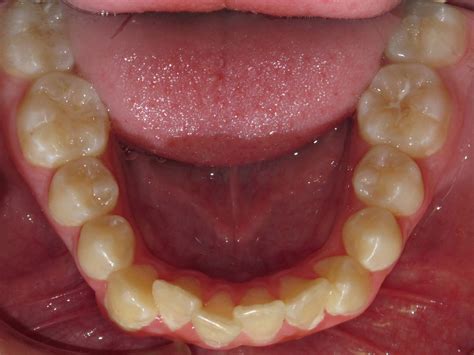 Occlusal Photo Of Mandibular Dentition Initial Nuss Birn Flickr