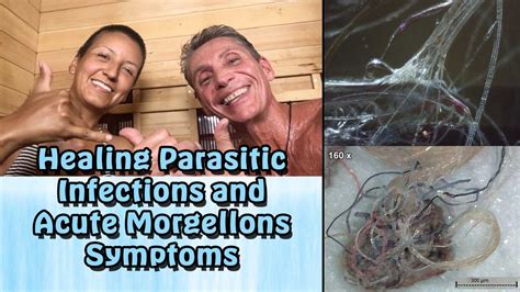 Healing Parasitic Infections And Acute Morgellons Symptoms Earther Academy