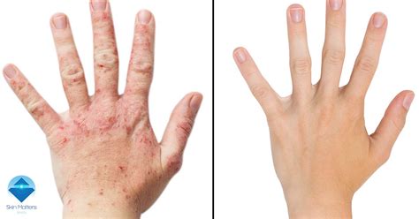 What Is Eczema And How Can Phototherapy Help Skin Matters Bristol