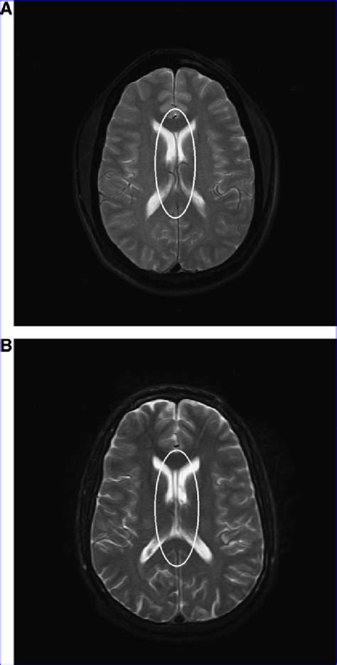 Cavum Septum Pellucidum Csp A Mild B Moderate No Severe Csp