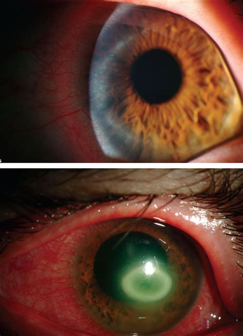 Pseudomonas Aeruginosa Infection In Eye Carpet Vidalondon
