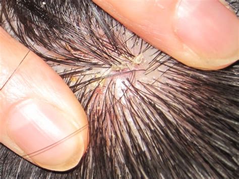 Natural And Alternative Treatments For Scalp Psoriasis