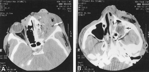 Pdf Traumatic Subluxation Of The Globe Into The Maxillary Sinus