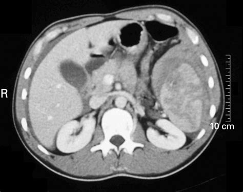 Infective Splenic Rupture Presenting With Symptoms Of A