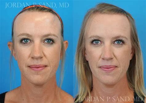 Reconstructive Spokane Center For Facial Plastic Surgery Free Hot