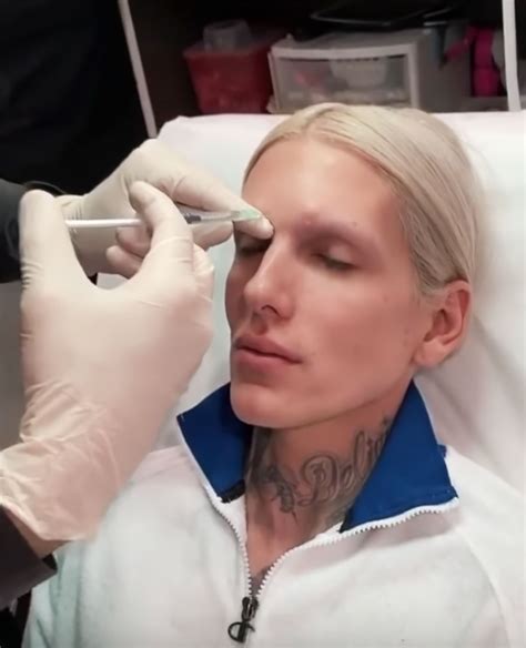 Jeffree Star Gets Botox Injections For The 1st Time Details