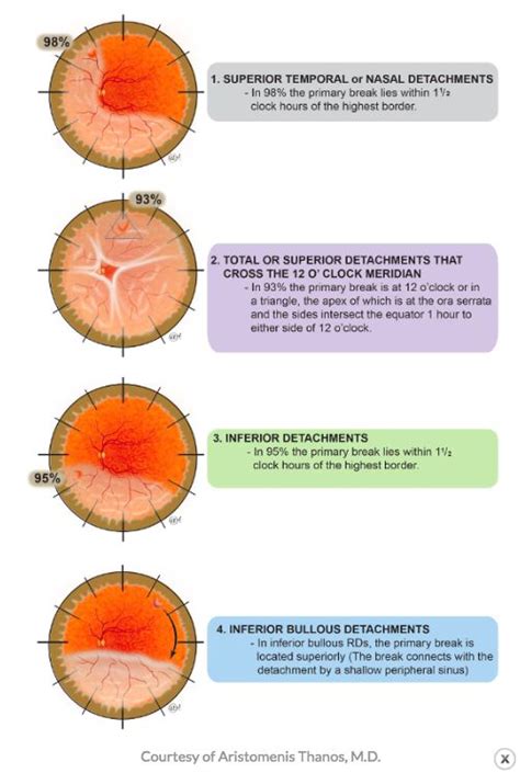 Lincoffs Rule Eye Health Facts Eye Facts Diseases Of The Eye