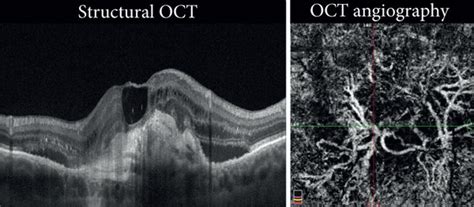 Cnv With Rpe Tears Structural Oct Shows Deconstruction Of The
