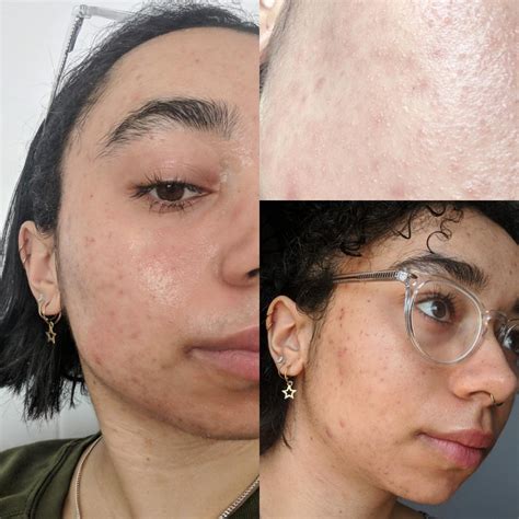 4 Day Progressrecovery From A Damaged Moisture Barrier Rtretinoin