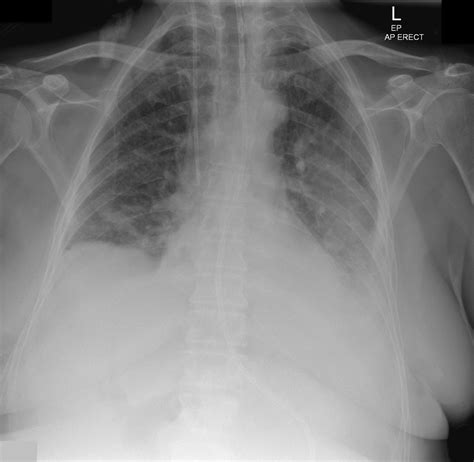Loculated Pleural Effusion X Ray 519 Scan Thoracic Photos Free