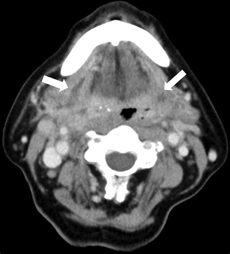 Double Tongue Signs In A Case Of Submandibular Space Infection Bmj