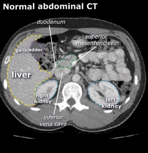 Abdominal Ct Scan Labeled Images And Photos Finder