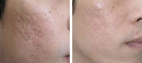 Microneedling Treatment Before And After Kingsway Dermatology