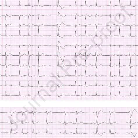 Three Additional Ecgs On Day 0 Showing Fluctuating Conduction