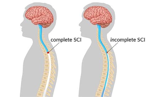 Cervical Spinal Cord Injury Functions Affected And Recovery