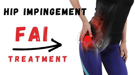 Femoroacetabular Impingement Syndrome Fai Hip Impingement Treatment For