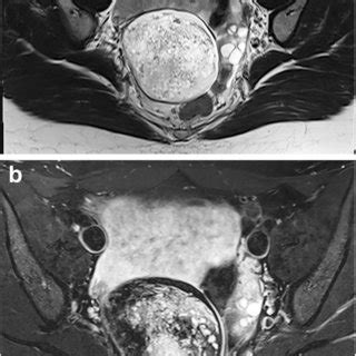 MRI Of Mature Cystic Teratoma In A 16 Year Old Girl A Coronal Oblique
