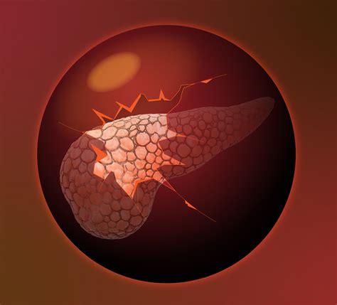Chemoresistance in pancreatic cancer: Disrupting cellular metabolism ...
