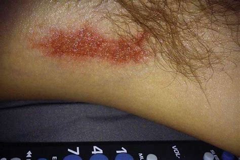 Class Action Lawsuit Claims Old Spice Deodorant Causes Chemical Burns Oozy Sores