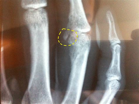X Ray Showing Bone Chip On Right Ring Finger