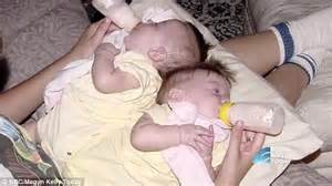Conjoined Twin Sisters Thriving 17 Years Later But Insist They Can