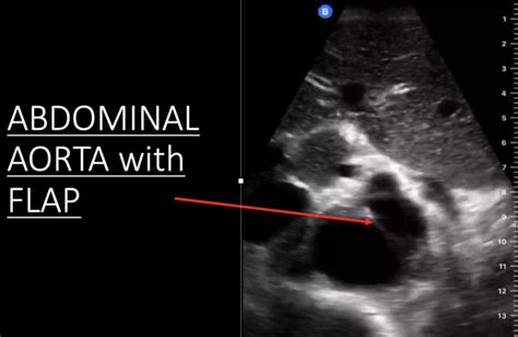 Aortic Dissection Annotated Still Image 3 Transverse Abdominal Aorta